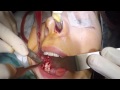 Extraction des dents de sagesse6