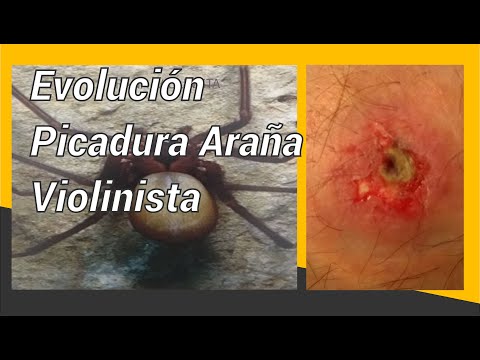 Vídeo: Mordeduras De Araña: Identifique Qué Mordió Y Obtenga Ayuda Adecuada