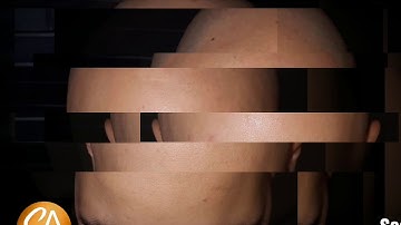 Scalp Micropigmentation by Renata.💥  Before and After 3 sessions 💥