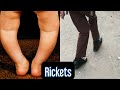 Rickets- Vitamin D Deficiency #mbbs #neetpg