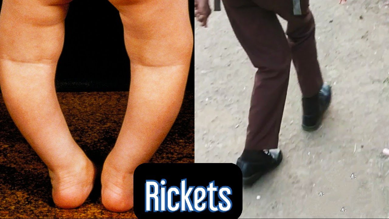 Rickets- Vitamin D Deficiency #mbbs #neetpg - YouTube