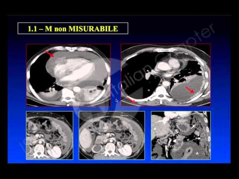 Video: Valutazione Della Risposta Di Immunoterapia Con Elastografia A Risonanza Magnetica (MRE) In HCC Avanzato