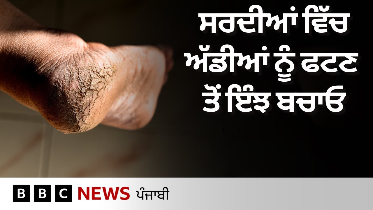 Cracked heels ਨੂੰ ਕਿਵੇਂ ਠੀਕ ਕੀਤਾ ਜਾ ਸਕਦਾ ਹੈ ਅਤੇ ਇਹ ਸਮੱਸਿਆ ਹੁੰਦੀ ਕਿਉਂ ਹੈ | 𝐁𝐁𝐂 𝐏𝐔𝐍𝐉𝐀𝐁𝐈