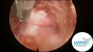 Amazing new footage of Dr Gabriele Jasper removing a herniated disc.