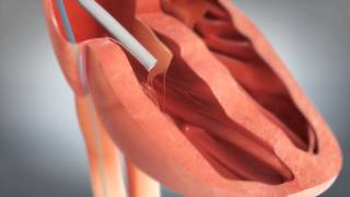 Mercy - St. Jude Medical - Animation of NanostimTM Leadless Pacemaker