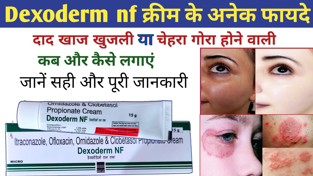 Dexoderm nf cream ke fayde | dexoderm nf | dexoderm nf cream review in ...