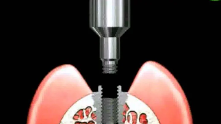 NeoBiotech Screw Remover Kit