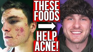 BEST FOODS TO GET RID OF ACNE (FROM EXPERIENCE) Resimi