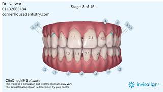 Narrow Arches, Maxillary Midline Deviation, Mandibular Midline Deviation, Midline Shift, Crowding