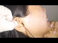 Removing something stuck in womans ear for days