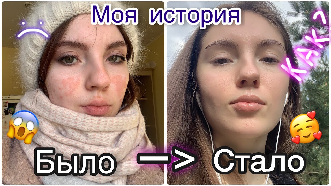 ИСЦЕЛИТЬ КОЖУ СИЛОЙ МЫСЛИ? Моя история.