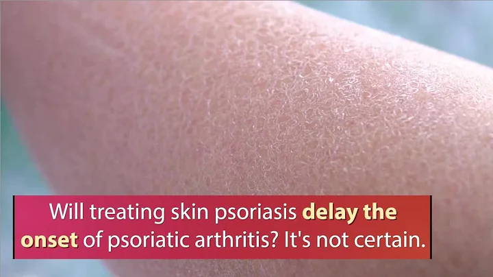 Psoriatic arthritis eludes early diagnosis