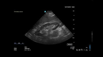 Sonosite PX Help Video - Taking Measurements