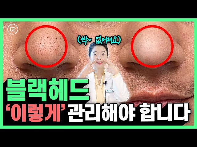 블랙헤드 없애는 방법 | 코팩, 바세린, 클렌징오일로 관리하는 분 꼭 보세요...!(큰일납니다)