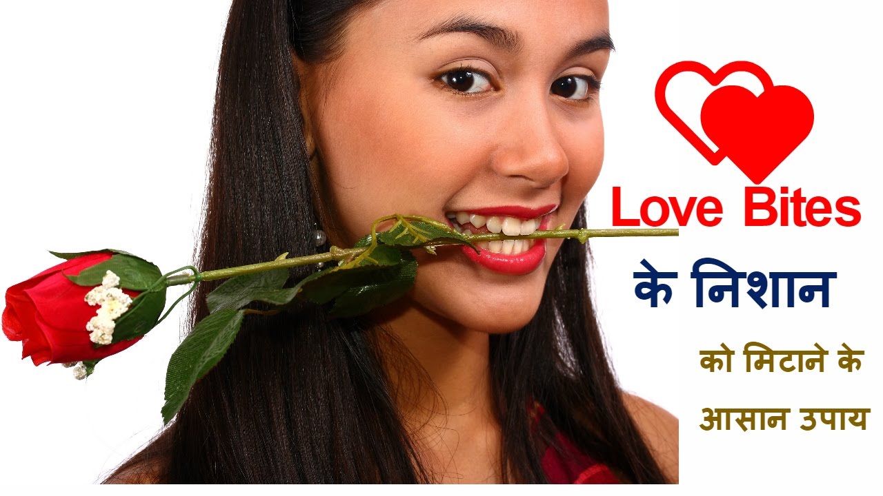 Love Bites के निशान को मिटाने के आसान उपाय/how to get rid of lave bites