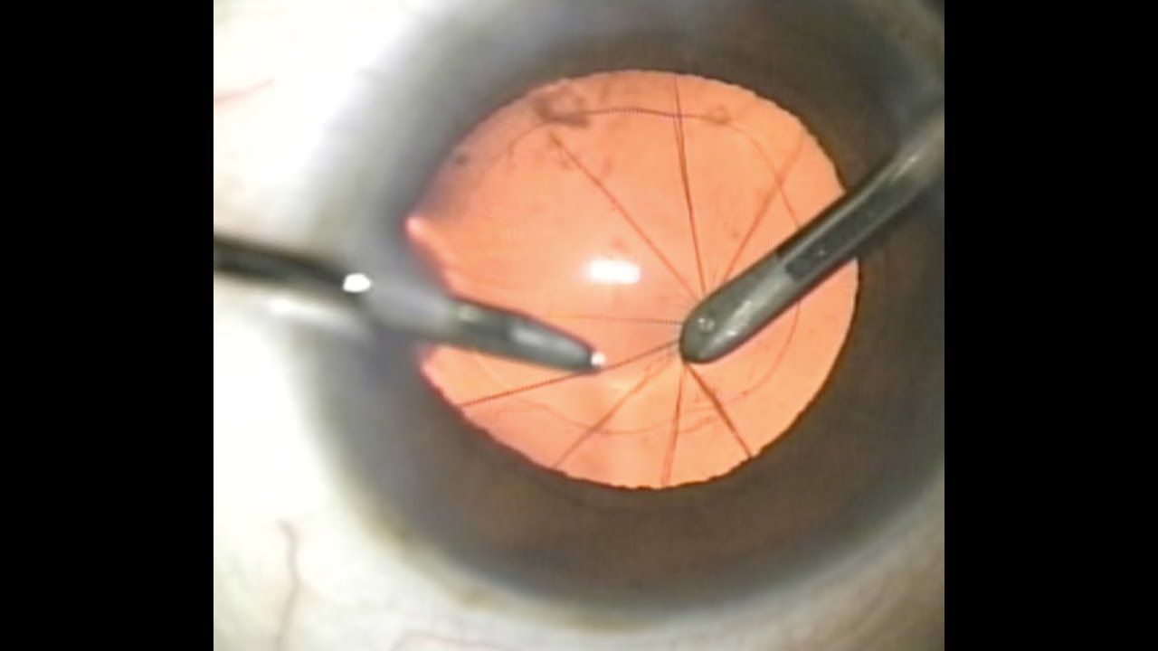 Posterior capsule rupture during I/A (end of surgery) YouTube