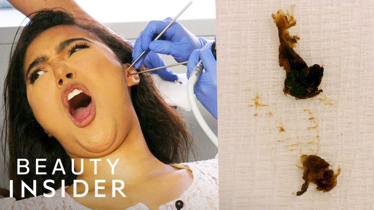 How Earwax Is Professionally Extracted | Beauty Explorers