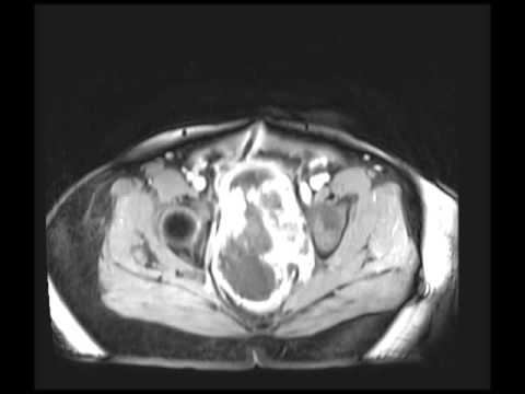 prostate sarcoma mri 2 trimeszter hanyadik héttől