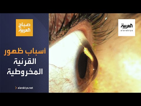 صباح العربية | ما أسباب ظهور القرنية المخروطية؟