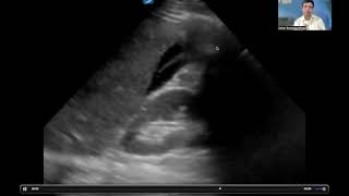 Point Of Care Ultrasound (POCUS) for the cardiac surgical patient