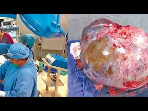 Video: 132-kilogramski Tumor Je Bil Odstranjen ženski