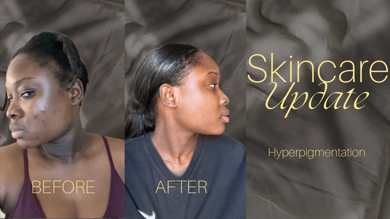 Update hyper pigmentation - This product 🔥
