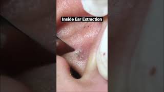Close up inside ear extraction  #extraction
