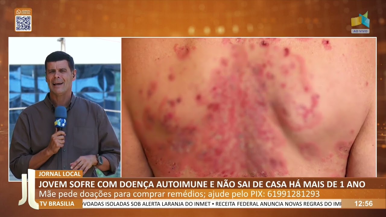 JL - Jovem sofre com doença autoimune e não sai de casa há mais de 1 ano