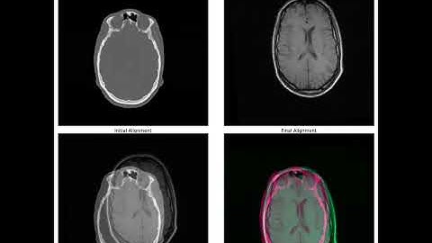 Intensity-based Registration of Medical Images using Mutual Information Metric