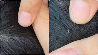 Close scalp view|| picked so much lice