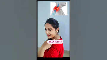 Exercise For Neck Hump 