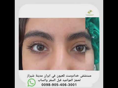 عمليات تجميل الجفون في مستشفى خدادوست للعيون