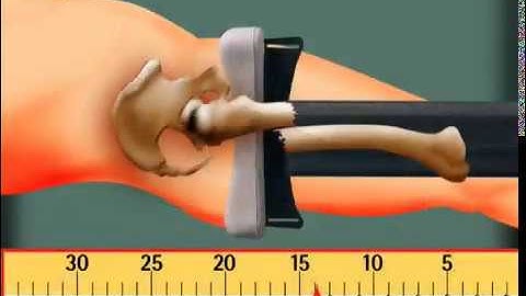 Sager, The Science of Traction Splinting