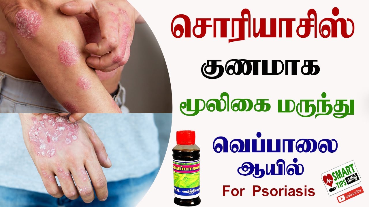 psoriasis siddha treatment in tamil a térd alatti lábakon vörös foltok fájnak
