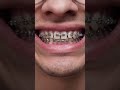 5 Month Braces Progress 🤯