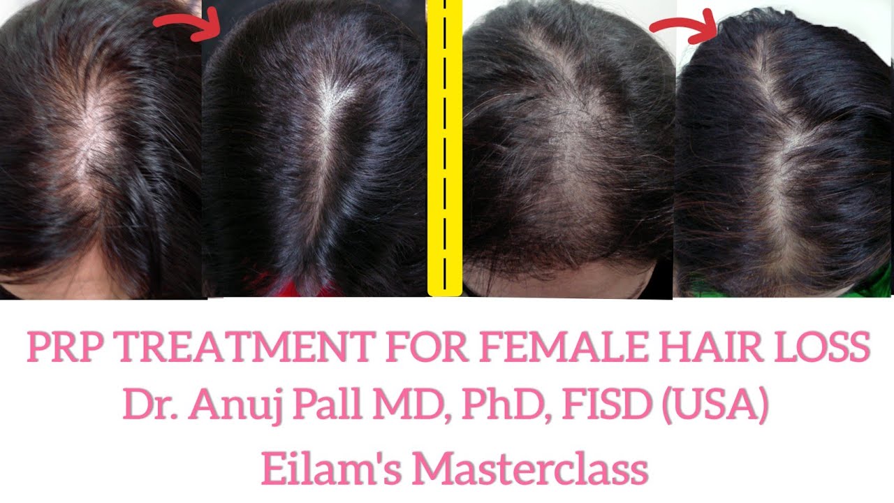 PRP treatment for female pattern hair loss - YouTube