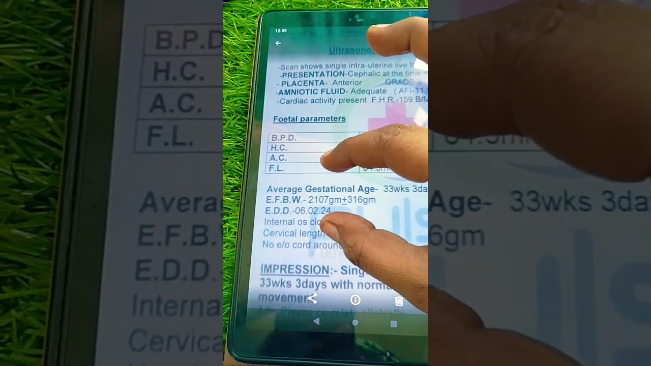 ultrasound m EDD ka kya matlab hota h # short video on YouTube ❤️ vi 