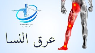 عرق النسا وعلاجه (الاسباب والاعراض والعلاجات والتمارين المناسبة وطرق الوقاية) العصب الوركي  و الدسك