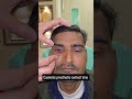 🌟 Cosmetic Prosthetic Lens 🌟 #bestvisioneyehospital