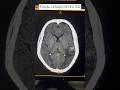 Brain CT Lesion TB or Fungal? Spot It #shorts