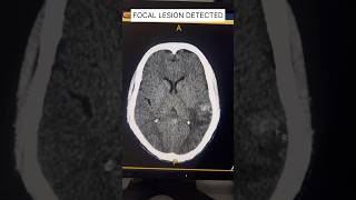 Brain CT Lesion TB or Fungal? Spot It #shorts