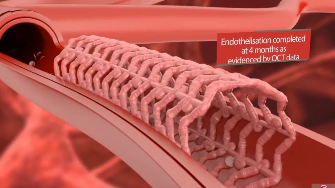 Στεφανιογραφία - Αγγειοπλαστική με τοποθέτηση Stent
