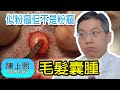 毛髮囊腫 | Pilar Cyst | 頭皮腫瘤 | 發炎 | 粉瘤 | 皮膚手術 |陳上熙醫生 | 皮膚專科