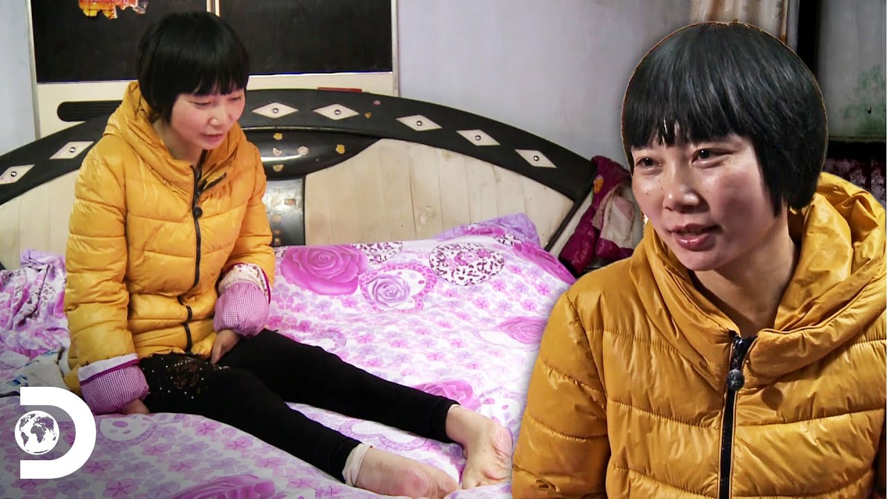 A impressionante história da mulher chinesa com mãos e pés invertidos | Meu Corpo, Meu Desafio