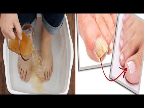 Video: A do të shërohet një thonj i ngulitur i këmbës? Pyetjet e shpeshta dhe të shpeshta për pyetjen e thonjve të futur në këmbë janë përgjigjur