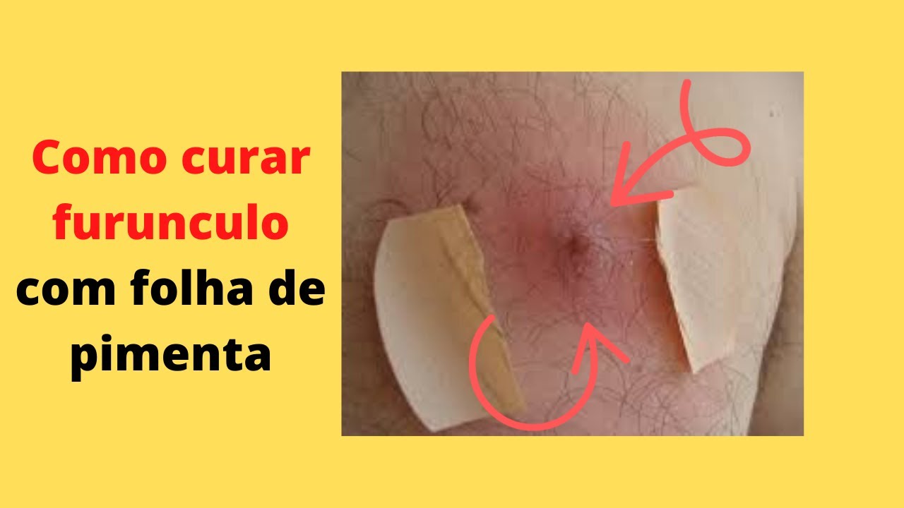 Como curar furunculo com folha de pimenta / remedio caseiro #publi ...