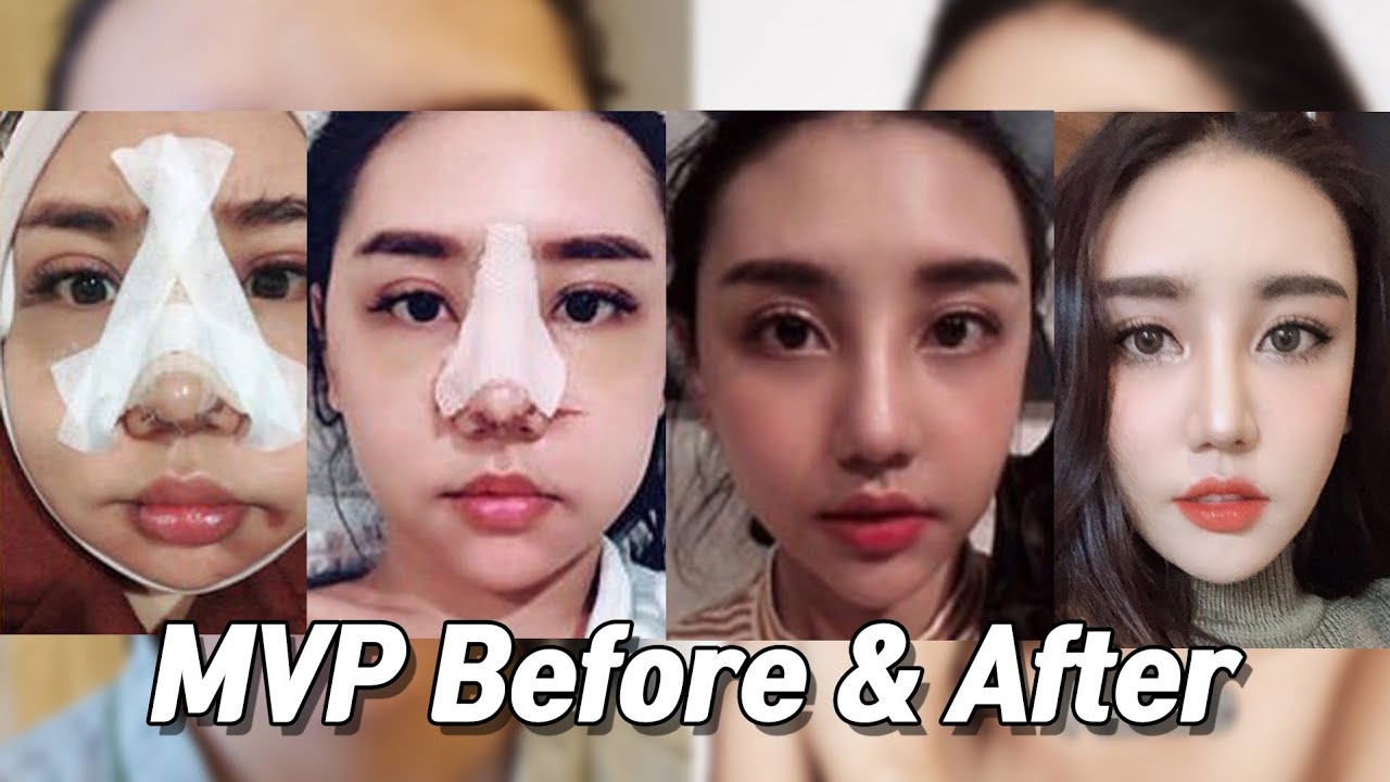 Korean Plastic Surgery Before and After (zygoma reduction and