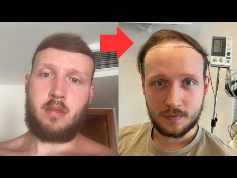 My ENTIRE BALDING JOURNEY AGE 17 - 23