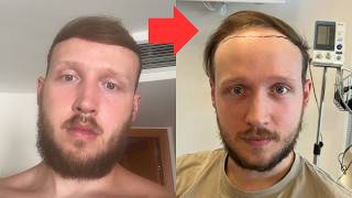 Balding Progression Age 17 to 23
