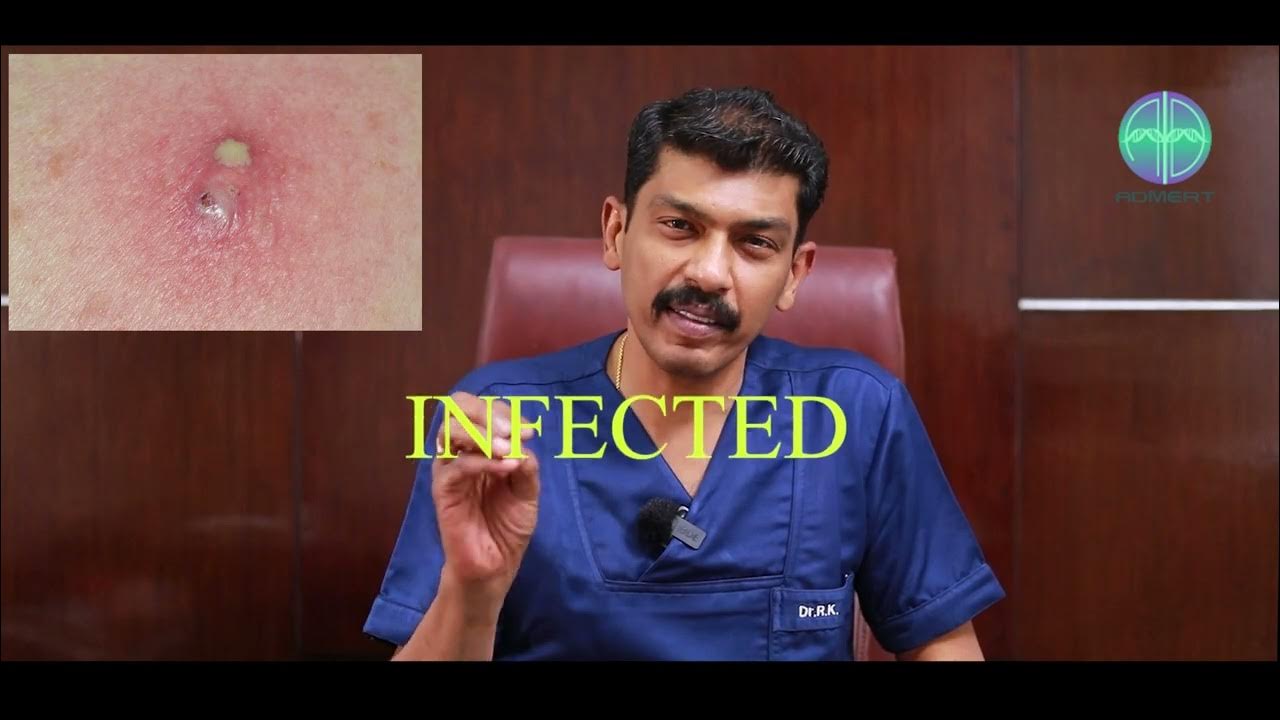 what-is-sebaceous-cyst-sebaceous-cyst-explained-in-tamil-dr